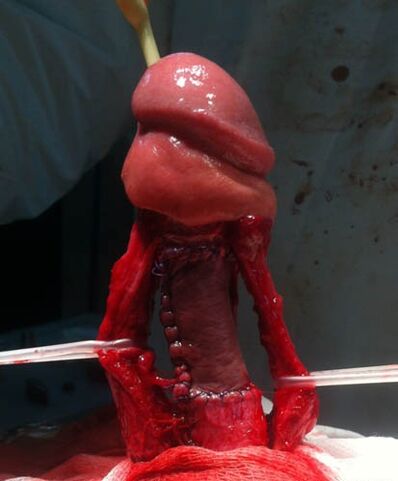 Operace zvětšení penisu